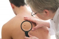 Neki dijelovi kože su povoljniji za širenje melanoma