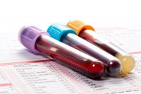 Test krvi detektuje rak dojke pet godina prije pojave simptoma