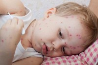 БиХ у рангу с афричким земљама по броју обољелих од морбила
