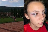 Masovne tučnjave fudbalerki u Goraždu, igračica Sane imala potres