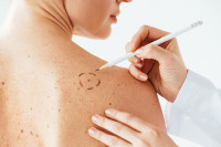 Veliki proboj na polju liječenja melanoma, naučnici pronašli način da izgladne rak