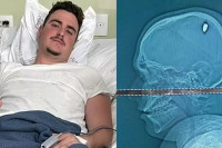 Student četiri dana nosio metak u glavi a da nije znao! (FOTO)