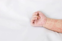Први случај малих богиња, дијете није било вакцинисано