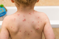 Koliko ima zaraženih morbilama u Srpskoj