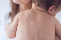  Morbilama zaraženo 93 lica