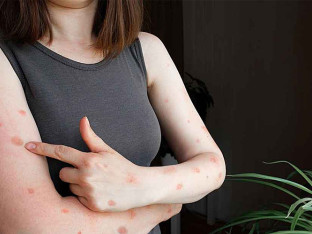 Naučnici tvrde da Mpoks virus može da inficira i ljudski mozak