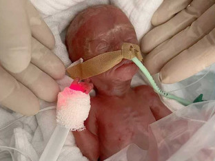 Ljekari spasili djevojčicu rođenu sa samo 300 grama!