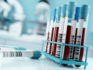 Ruski naučnici razvili novi krvni test za rano otkrivanje raka materice