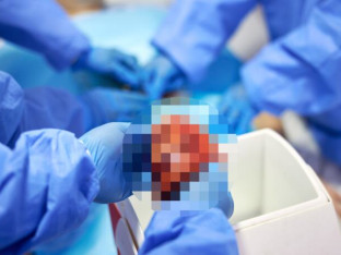 Prvi put u istoriji medicine čovjeku presađeni jetra i bubrezi genetski modifikovane svinje