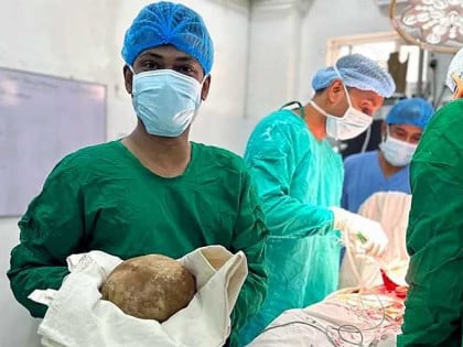 Свјетски рекорд: Уклоњен највећи камен из бешике на Шри Ланки
