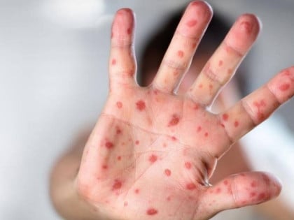 Muškarac preminuo od majmunskih boginja nakon moguće zaraze u bolnici